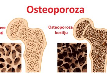 Svetski Dan borbe protiv osteoporoze