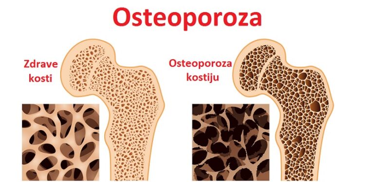 Svetski Dan borbe protiv osteoporoze