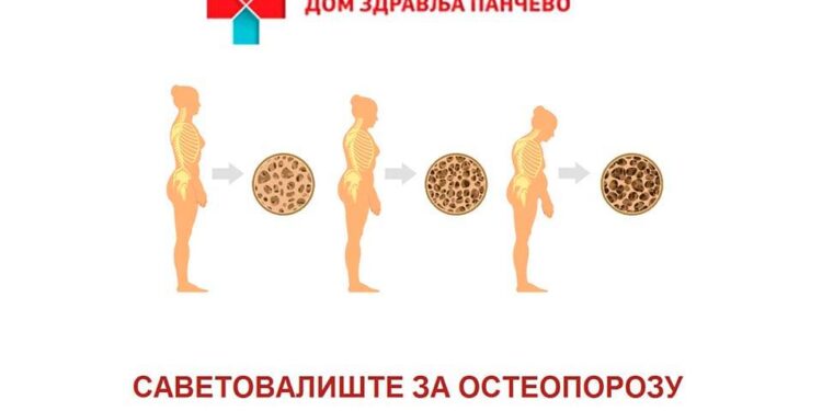 U Pančevu radi Savetovalište za osteoporozu